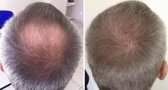 how to regrow hair in bald spots
